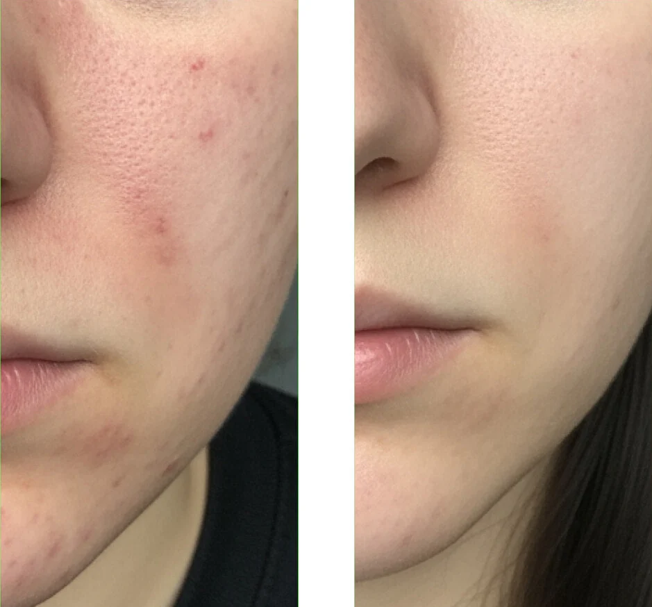 Salicylic Acid Cleanser for blemishes and pores — Salicylic Acid Face Wash purifies oily skin, removes blackheads, and refreshes the complexion. Contains Salicylic acid. - Image 6