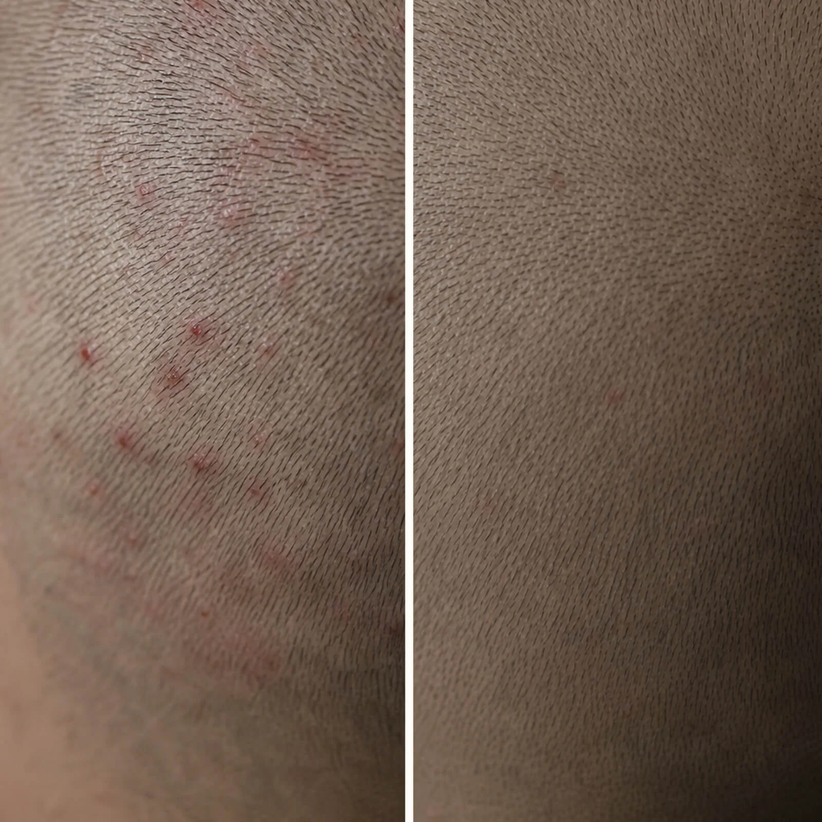 Salicylic Acid Gel for Pimples on Scalp & Itchy Bumps — How to get rid of pimples on your scalp? Use our Salicylic Acid Gel to exfoliate pores and soothe itchy, red, and painful spots instantly. - Image 7