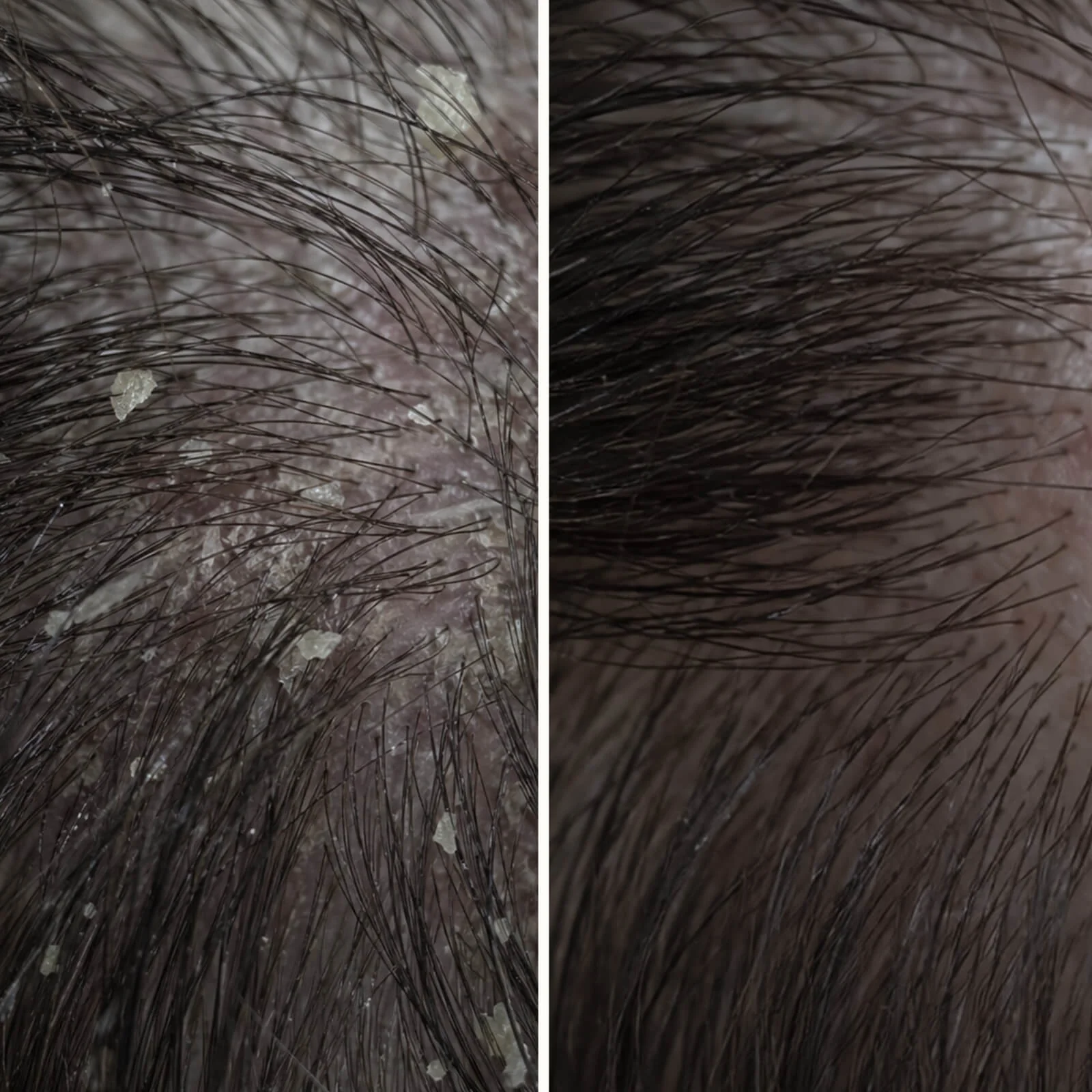 Salicylic Acid Scalp Treatment for oily & flaky scalp — Salicylic Acid Pre-Wash Treatment relieves itchiness, flakes, and oil. Use before washing for deep exfoliation with active Salicylic Acid. - Image 7