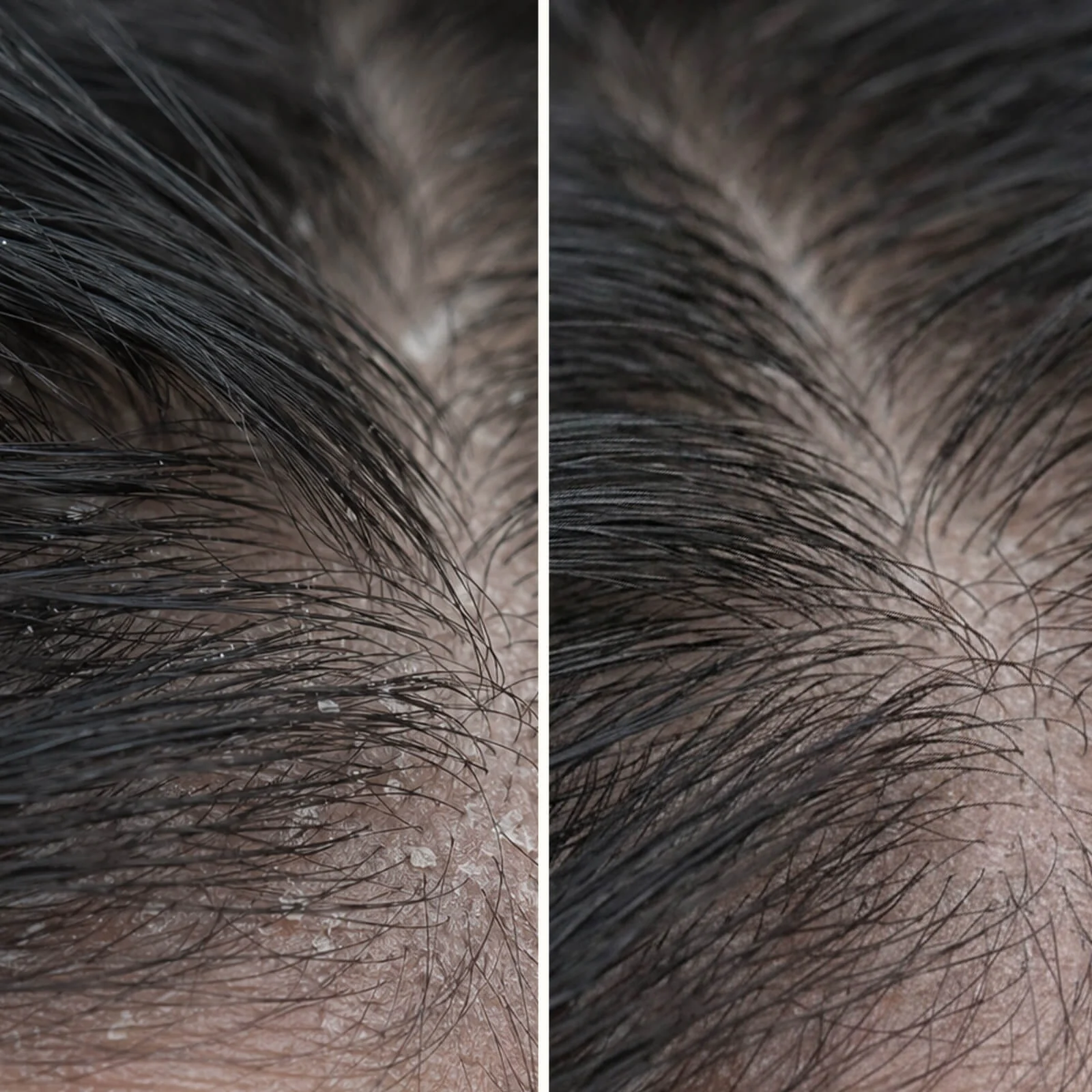 Salicylic Acid Scalp Treatment for oily & flaky scalp — Salicylic Acid Pre-Wash Treatment relieves itchiness, flakes, and oil. Use before washing for deep exfoliation with active Salicylic Acid. - Image 8
