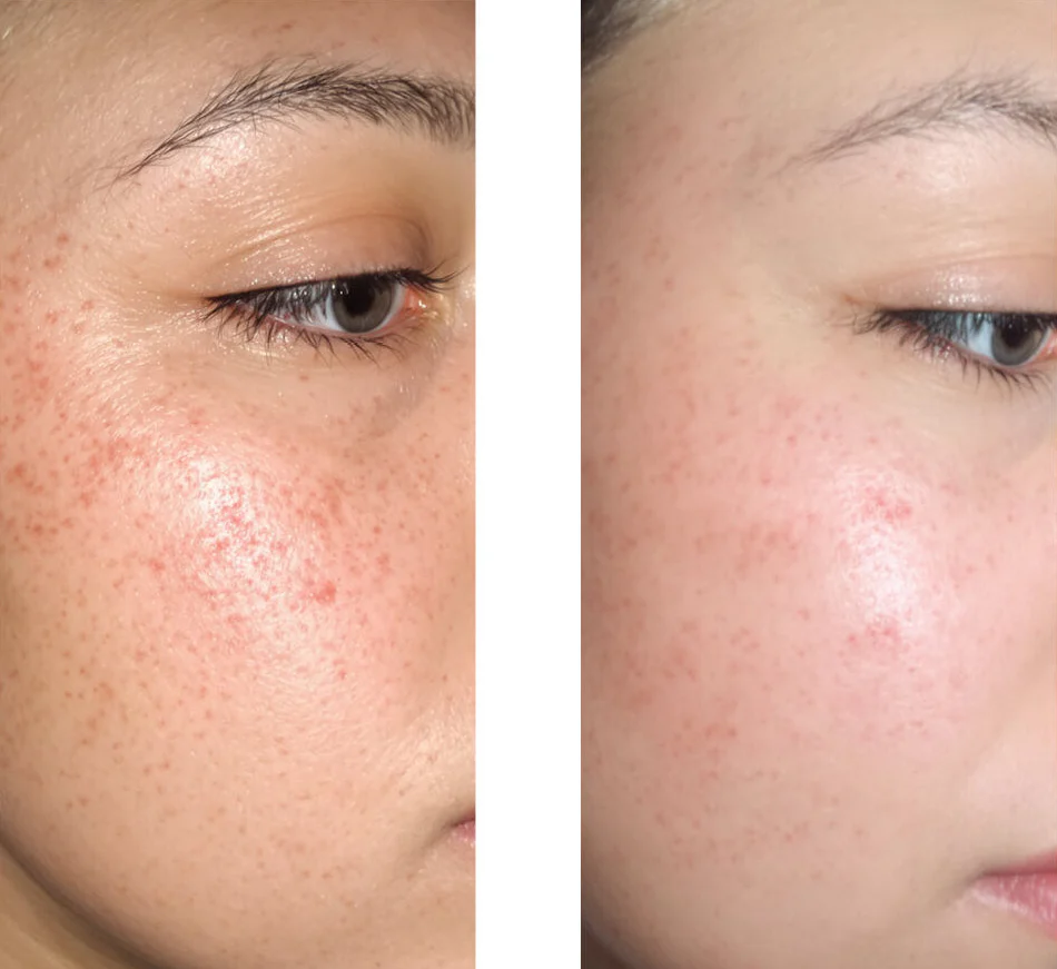 Salicylic acid serum for blemishes, oily skin and pores — Salicylic acid serum for blemishes, oily skin and pores. With Zinc PCA, green tea, hyaluronic acid and glycerin. - Image 6