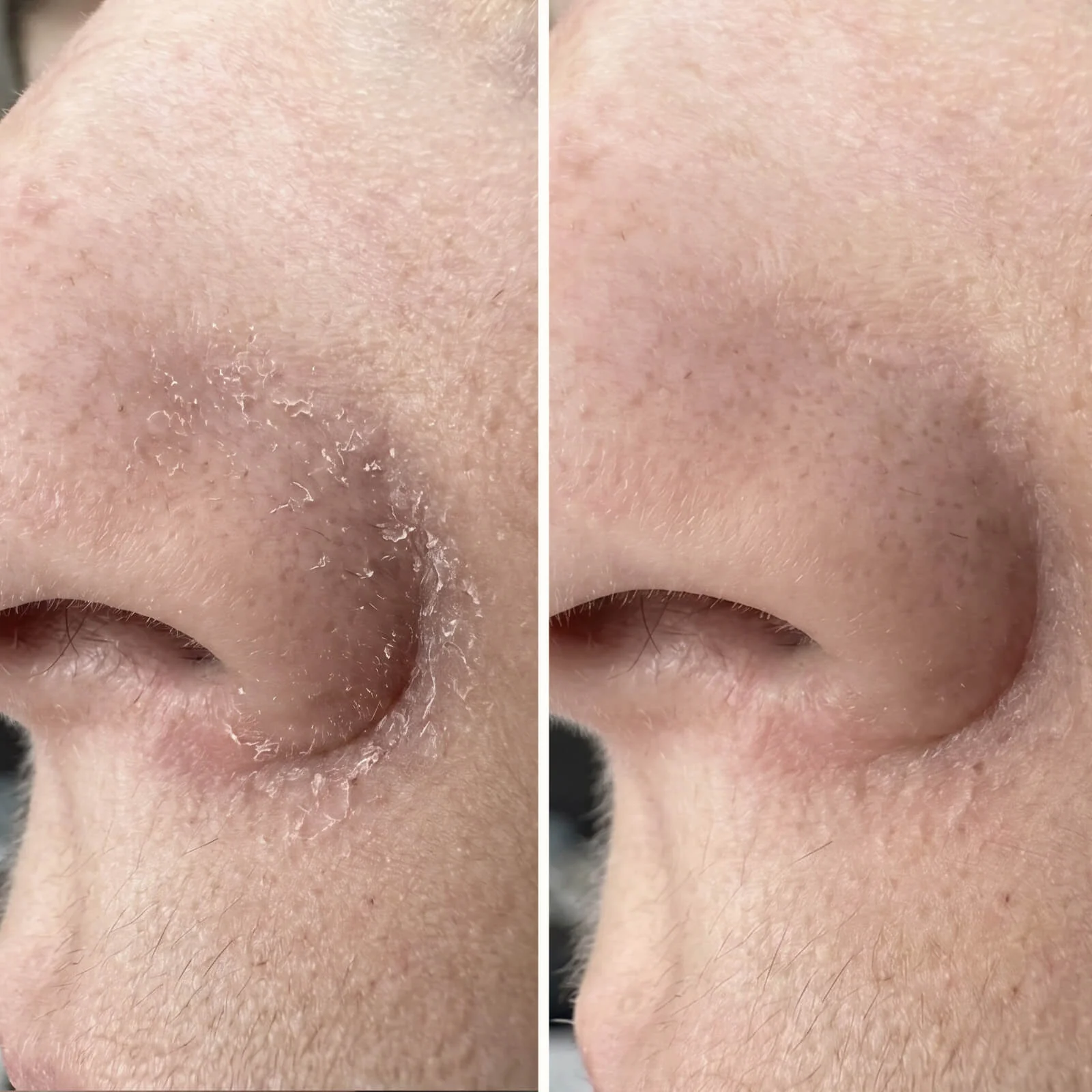 Salicylic Acid Serum – For Beard & Facial Dandruff — Effective serum for beard dandruff and seborrheic dermatitis. Salicylic Acid clears flakes and redness fast to restore skin balance. - Image 6