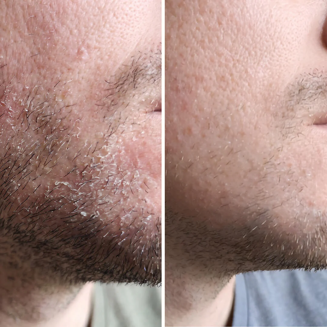 Salicylic Acid Serum – For Beard & Facial Dandruff — Effective serum for beard dandruff and seborrheic dermatitis. Salicylic Acid clears flakes and redness fast to restore skin balance. - Image 8
