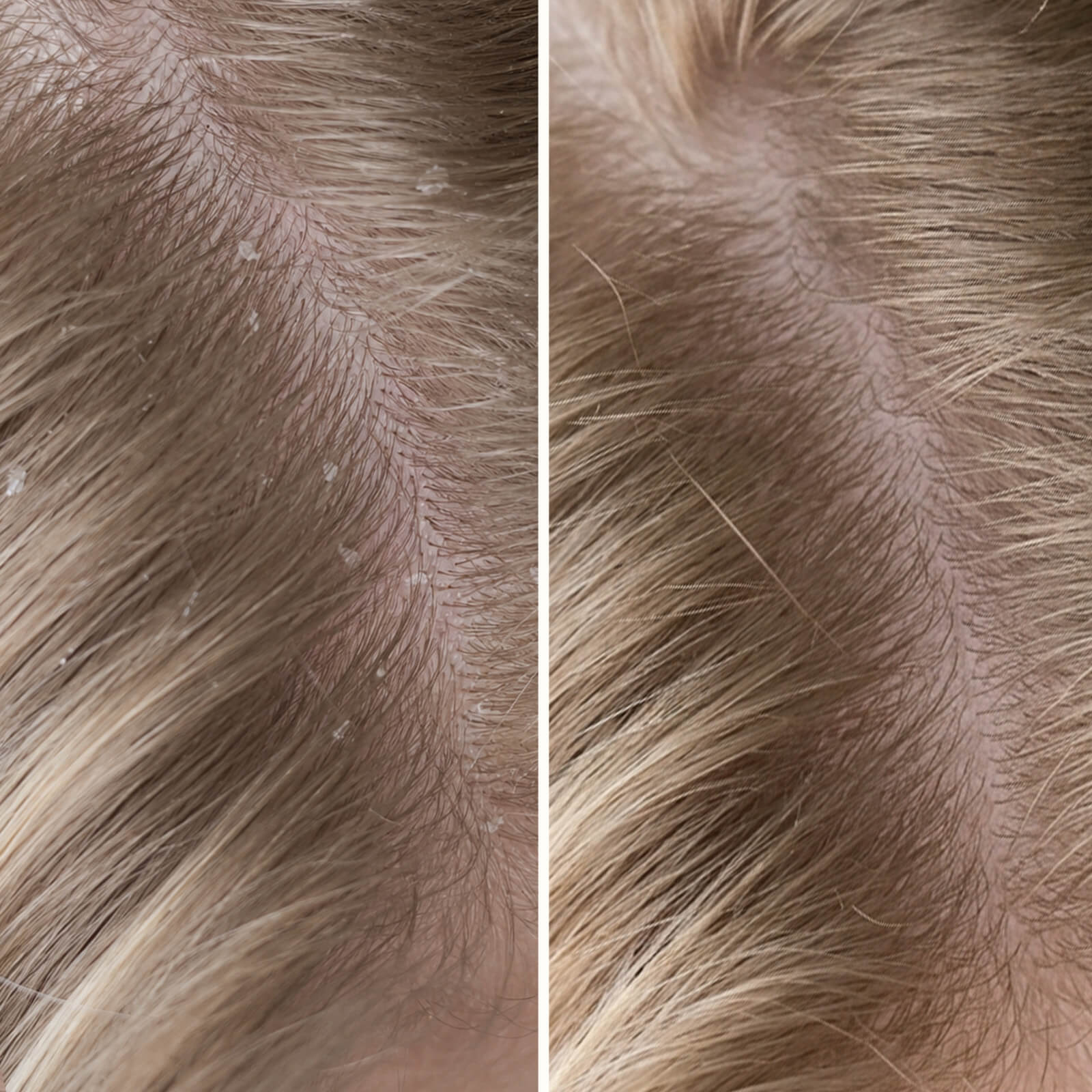 Salicylic Acid Shampoo for Dry & Itchy Scalp — Get rid of an itchy scalp and dandruff with this shampoo. Soothes dry skin and removes dead skin cells with Salicylic Acid. - Image 7