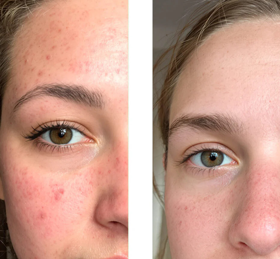 Salicylic Acid Toner for Breakouts and Large Pores — This BHA exfoliant clears pores, fights blemishes and smooths skin texture. Use daily for clearer, healthier skin. - Image 6